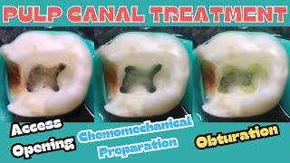 Pulp Canal Treatment 🟢 mandibular second primary molar ⚪️ access opening 🟡 cmp 🔵 obturation [upl. by Iramohs]