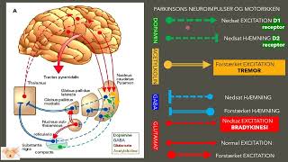 Challenges with Parkinsons disease [upl. by Erihppas548]