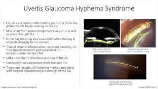 Lecture UveitisGlaucomaHyphema Syndrome 1 Slide in 5 Minutes [upl. by Hpesoj]