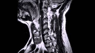 Cervical Spine Pain and Radiculopathy with disc protrusion MRI  San Leandro Chiropractor [upl. by Elorac]