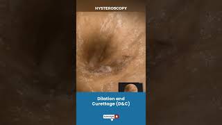 बच्चेदानी Uterus का Dilation और Curettage  Procedure for removing unwanted tissue in uterus [upl. by Lemire]