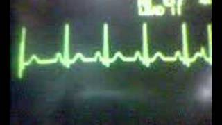 ECG Video Ectopics  Atrial [upl. by Siraval]