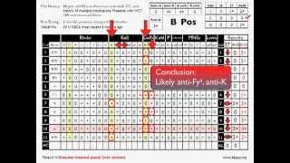 Antibody ID Basic Cases Part 2 [upl. by Mairb304]