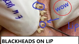 REMOVAL BLACKHEADS ON LIP AND FACE n7  LOAN NGUYEN [upl. by Nettie]