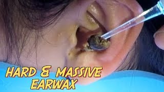 Girls Hard amp Massive Free Earwax Removal in the City [upl. by Eednac]