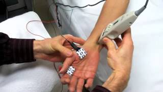 Median Motor Nerve Conduction Study [upl. by Erving871]