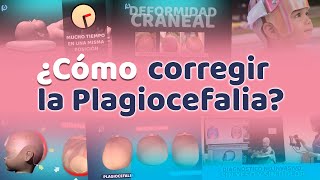 ¿Como corregir la plagiocefalia Plagiocefalia Argentina [upl. by Hillary]