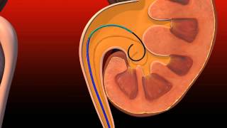 Ureteral Obstruction  Retrograde insertion of Resonance stent [upl. by Geraud830]