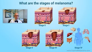 What are the stages of melanoma [upl. by Analed197]