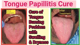 Tongue infectionGlossitis how to cure Fungal infection inside mouthTongue burning sensation cure [upl. by Eirehc]