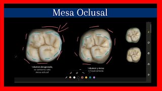 Morfología en digital primer molar superior Mesa Oclusal [upl. by Bucella]