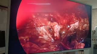 ruptured liver abscess with purulent peritonitis [upl. by Squire70]