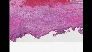 Histopathology GallbladderChronic cholecystitis [upl. by Juno]