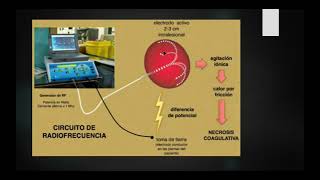 ABLACIÓN POR RADIOFRECUENCIA EN RENAL [upl. by Latreese]