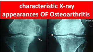 How to diagnose Osteoarthritis by xray [upl. by Duquette630]