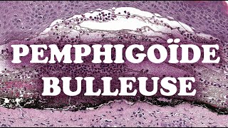 LA PEMPHIGOÏDE BULLEUSE  PATHOLOGIE [upl. by Rosita]