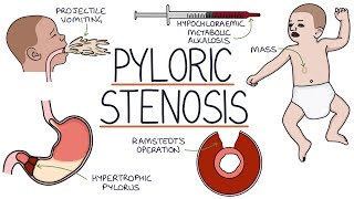 Understanding Pyloric Stenosis [upl. by Cheney315]