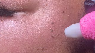 DPN Dermatosis Papulosa Nigra Removal [upl. by Ishii]