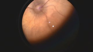 Retinopathy of Prematurity [upl. by Nicolas]