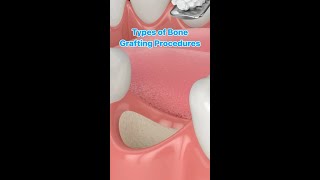 Bone Grafting [upl. by Ilyah603]