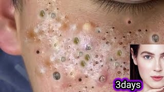 blackhead and whiteheads removal👌facial how to reduce acnepimpleblackheadsget fairclear skin [upl. by Sehguh157]