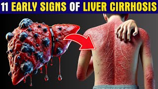 LIVER is DYING 11 Early Warning Signs of Liver Cirrhosis You Cant Ignore  Healthy Care [upl. by Annawaj216]