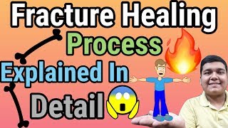 FractureBone Healing Process Explained [upl. by Hamnet]