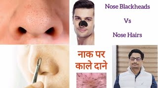 Trichostasis Spinulosa  Nose Blackheads  Nose Hairs  Nose Acne नाक पर काले दाने और बाल nosehair [upl. by Teodoro]