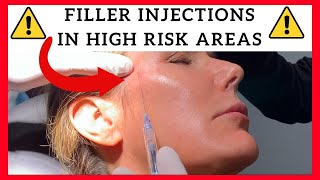 Filler Injections in High Risk Areas Temples Forehead Tear Trough Preauricular and Jawline [upl. by Tnecillim]