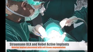 Straumann BLX and Nobel Active in the aesthetic zone with soft tissue augmentation [upl. by Checani]