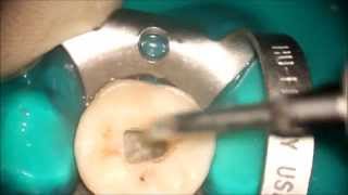 Second Mandibular Molar  Endodontic acces cavity [upl. by Malonis]