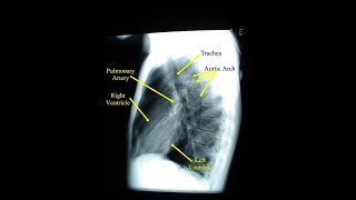 Lateral View of A Chest Xray  Definition structures and Uses [upl. by Hortense]