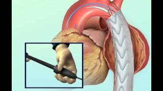 Aorta Stent Animation [upl. by Ettelorahc]