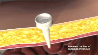 Full Fascial Port Site Closure with the Carter Thomason CloseSure System [upl. by Ginnifer]