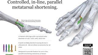 Mitigate Weil Osteotomy Complications Phantom Metatarsal Shortening System [upl. by Kolva]