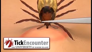 How to Remove a Tick [upl. by Tiertza]