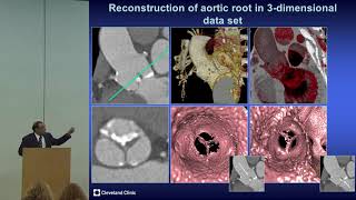 Imaging in Marfan Syndrome [upl. by Nnaillij]