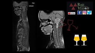 EPENDYMOMA WITH DROP METASTASIS [upl. by Odnumyar984]