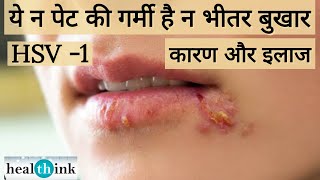 होंठों पर फोड़े। कोल्ड सोर के लक्षण और इलाज। cold sore or Fever blister symptoms amp treatment [upl. by Isiad]