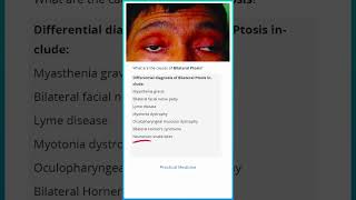 Causes of Bilateral Ptosis [upl. by Busey479]