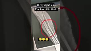 tibia fibula xray hospital hostellife shortsfeed shortvideo youtubeshort youtuber [upl. by Jacinto]