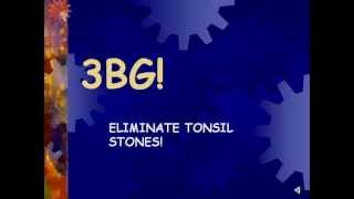 3BG ELIMINATE TONSIL STONES FAST [upl. by Gower]