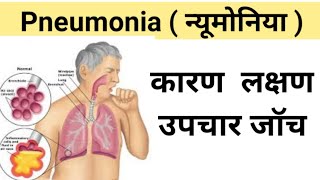 Pneumonia in hindi  pneumonia ke lakshan  निमोनिया के लक्षण और उपाय  pneumonia in covid 19 [upl. by Worden]