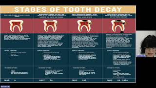 Tooth decay Definition Epidemiology of caries prevalence and intensity of caries [upl. by Pfeifer]