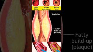 Atherosclerosis  shorts medical disease trending nursingking nursing mbbs [upl. by Eninnej]