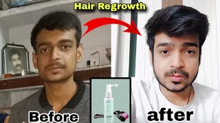 MINOXIDIL 5 Result  2 years Completed  Mars by ghc Minoxidil amp Man Matters Minoxidil Review [upl. by Icak]