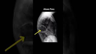 Lung AbscessAbses paru xray anatomy radiology abscess lungs pulmonology chest [upl. by Hsan]