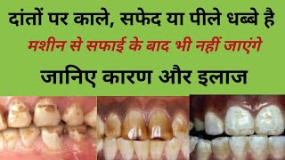 दांतों पर से काले सफेद या पीले धब्बे कैसे साफ करेंteeth fluorosis treatment teeth cleaning [upl. by Erfert]