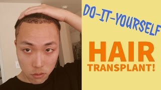 DoItYourself DIY Hair Transplant Possible [upl. by Gareri165]