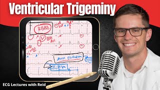 Ventricular Trigeminy EKG  ECG Lecture [upl. by Sidnal]